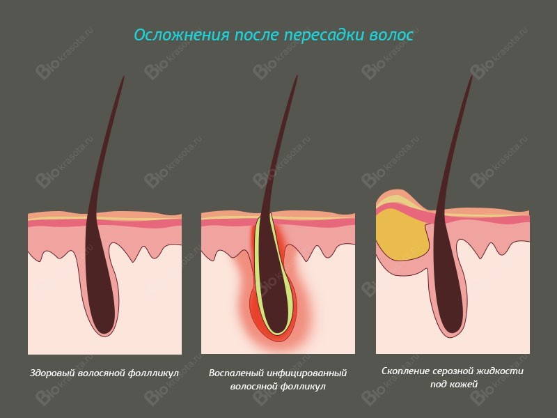 Уход за кожей после пересадки кожи Уход за кожей после пересадки кожи