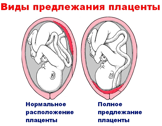 Предлежание плаценты многоплодная беременность Предлежание плаценты многоплодная беременность