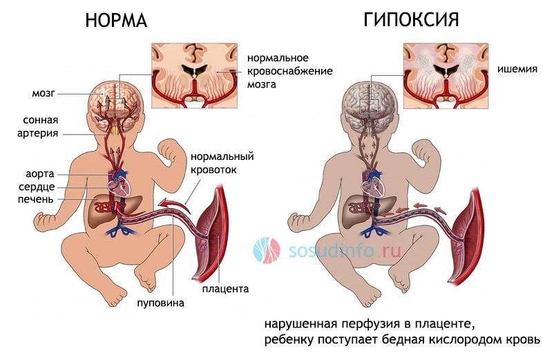 Церебральная ишемия у новорожденных как лечить Церебральная ишемия у новорожденных как лечить