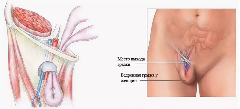 Варикозное Расширение Вене На Половой Губе