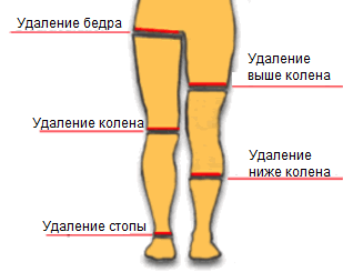 Уровне нижней трети голеней. Ампутация нижней конечности. Уровни ампутации нижней конечности. Ампутация нижней конечности на уровне бедра. Ампутация ноги выше бедра.