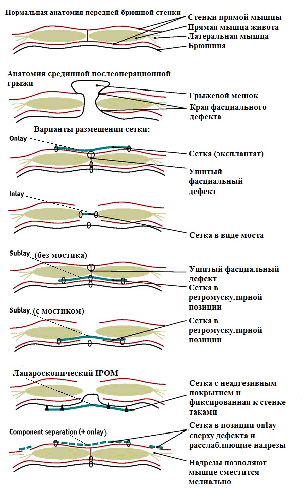 Грыжа передней брюшной стенки. Пластика передней брюшной стенки sublay. Пластика передней брюшной стенки onlay. Слои брюшной стенки. Sublay пластика грыжи передней брюшной стенки.