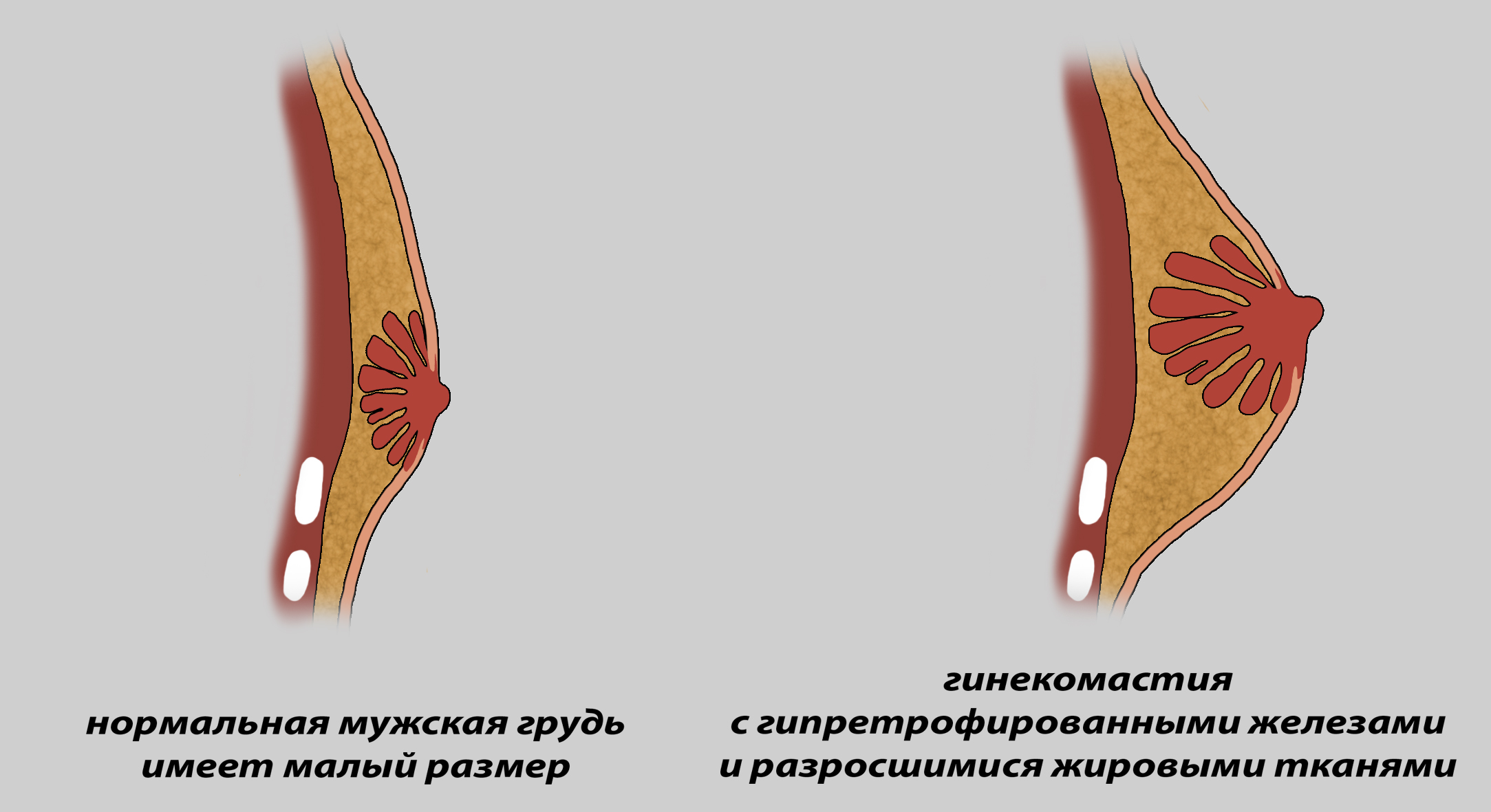 Почему молочные железы. Фиброзная гинекомастия. Гипертрофия жировой ткани молочной железы. Гинекомастия молочной железы. Гинекомастия пролиферирующая.