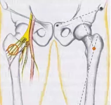 Невропатия бедра нерва. Невропатия бедренного нерва. Невропатия тазобедренного нерва. Неврит тазобедренного нерва. Нейропатия тазобедренного нерва.