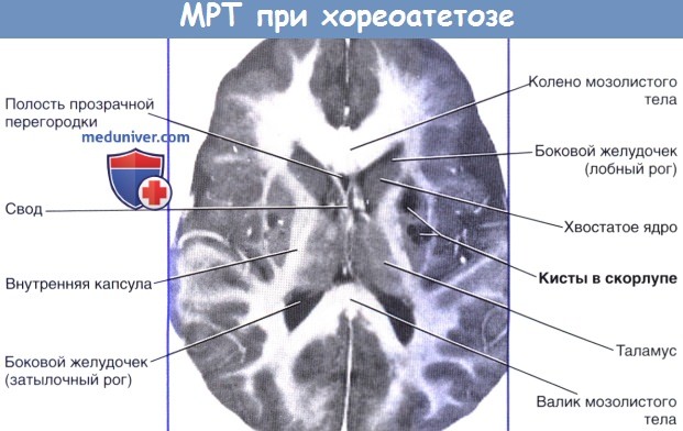 Полость прозрачной перегородки. Киста прозрачной перегородки головного мозга. Расширение прозрачной перегородки головного мозга. Расширение полости прозрачной перегородки.