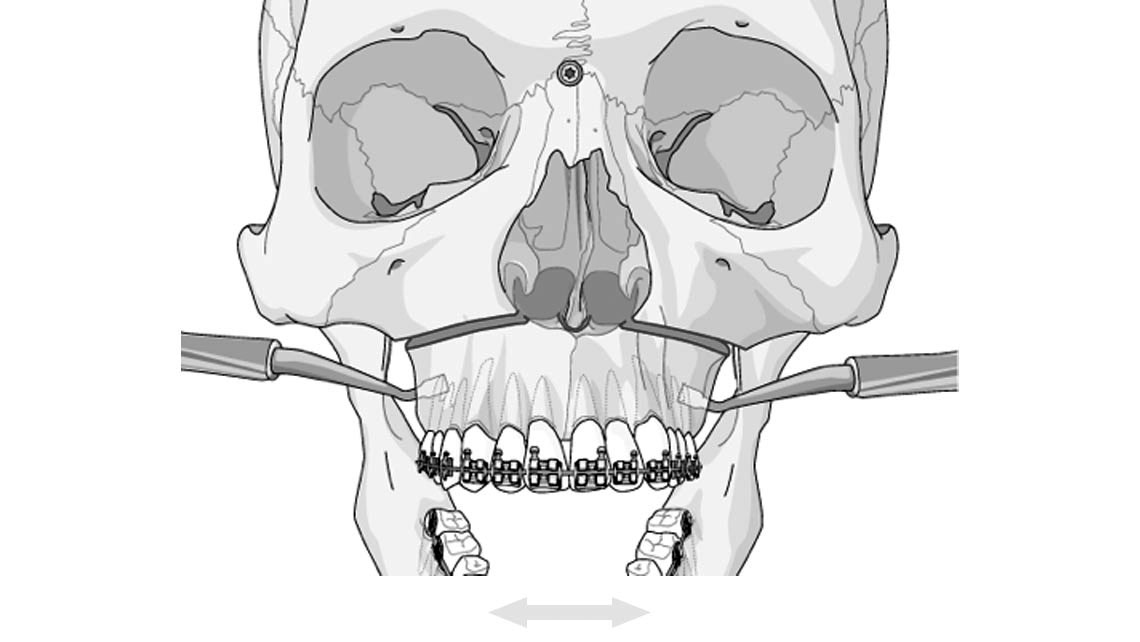 Расширения операция. Расширение верхней челюсти хирургия. Ортогнатическая операция верхней челюсти расширение. Расширение челюсти расширение ортогнатическая. Остеотомия верхней челюсти по le Fort i.