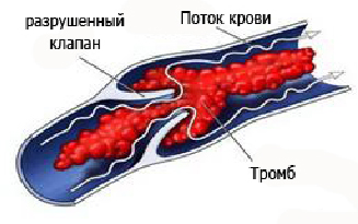Тромбоз артерии мкб 10. Посттромбофлебитический синдром нижних конечностей. Постфлебитический синдром. ПТФС глубоких вен нижних конечностей.