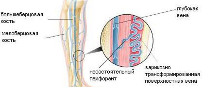 Перфорантные вены нижних конечностей это