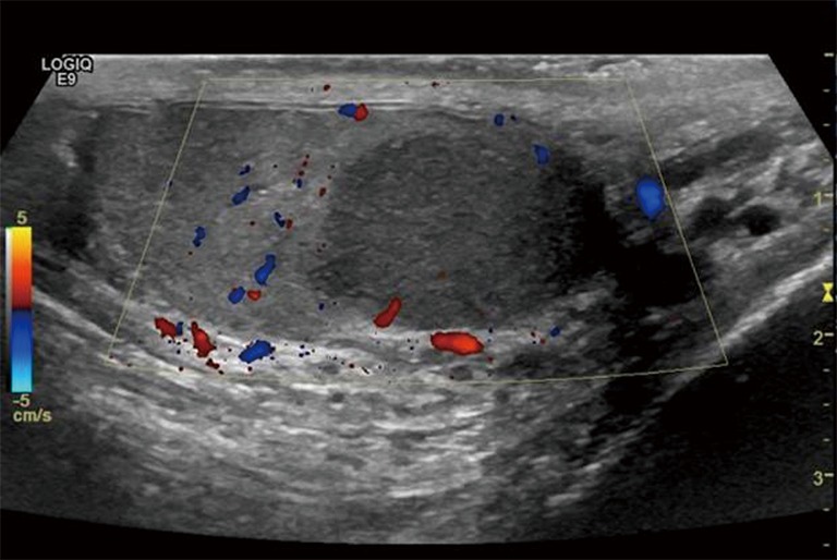 Узи яиц. Опухоль яичка семинома УЗИ. Опухоли придатка яичка на УЗИ.