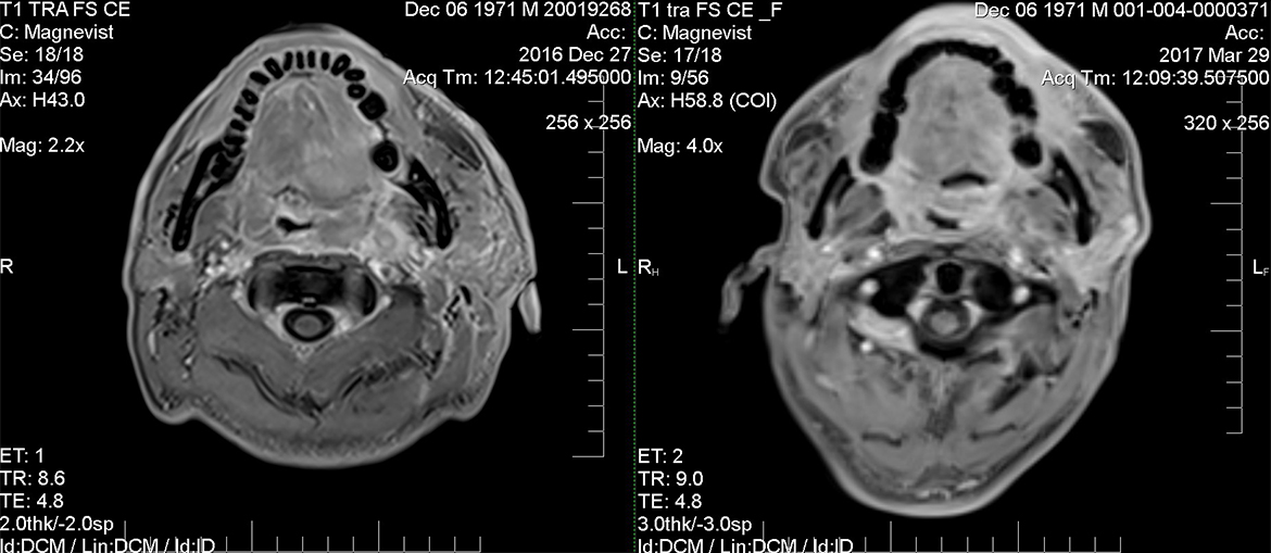 Метастазы рака ротоглотки. Метастазы рака ротоглотки. Кт анатомия слюнных желез. Небные миндалины анатомия кт. Кт анатомия ротоглотки.