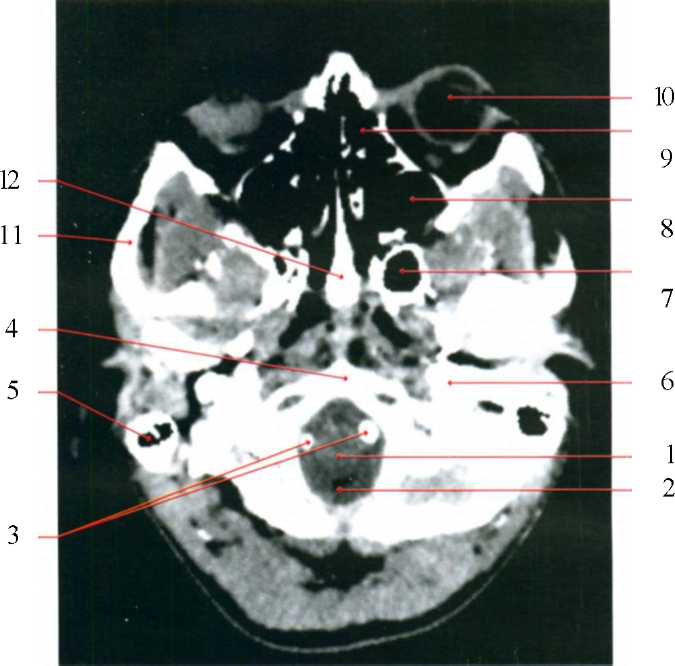 Кт анатомия черепа. Анатомия затылочной кости на кт. Клиновидная пазуха на кт. Кт анатомия клиновидной кости кт. Скат затылочной кости кт.