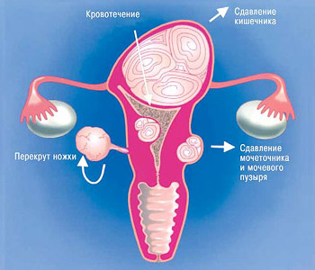 Живот при миоме матки фото