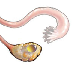 Киста желтого тела яичника на узи. Киста желтого тела строение. Лютеиновая киста яичника на узи. Киста желтого тела по узи описание. Киста желтого тела при беременности на ранних.