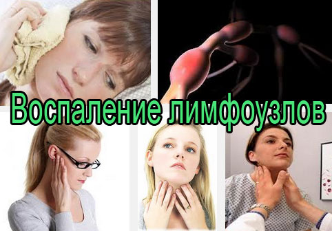 Как снять воспаление лимфоузла в домашних условиях