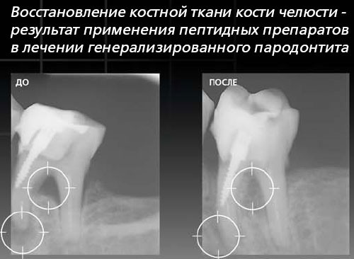 Костная Ткань Зуба Фото