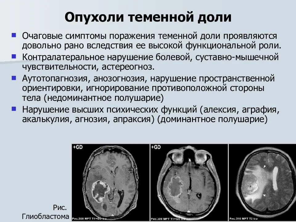 Опухоль головного мозга причины возникновения