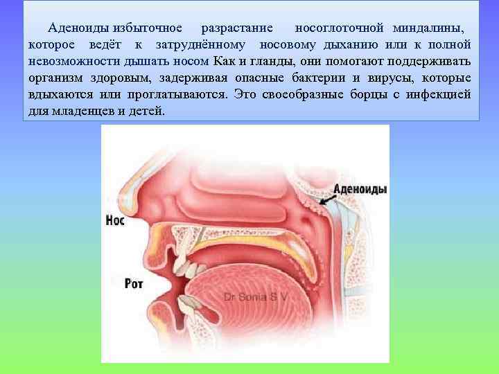 Где аденоиды у ребенка. Придаточные пазухи носа. Миндалины, аденоиды.. Аденоиды носоглоточные миндалины. Строение горла аденоиды.