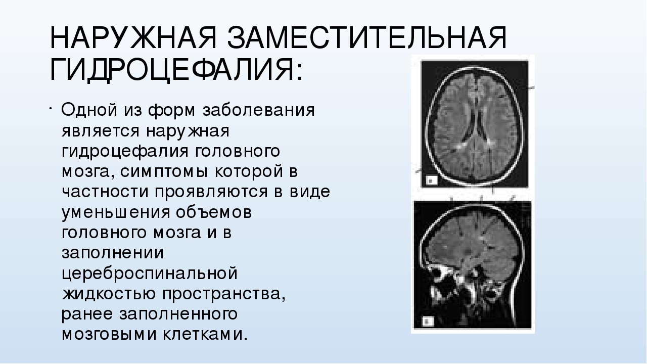 Как лечить гидроцефалию мозга. Наружная гидроцефалия головного мозга мрт. Заместительная наружная гидроцефалия кт. Гидроцефалия головного мозга на кт. Наружная и внутренняя гидроцефалия головного мозга.