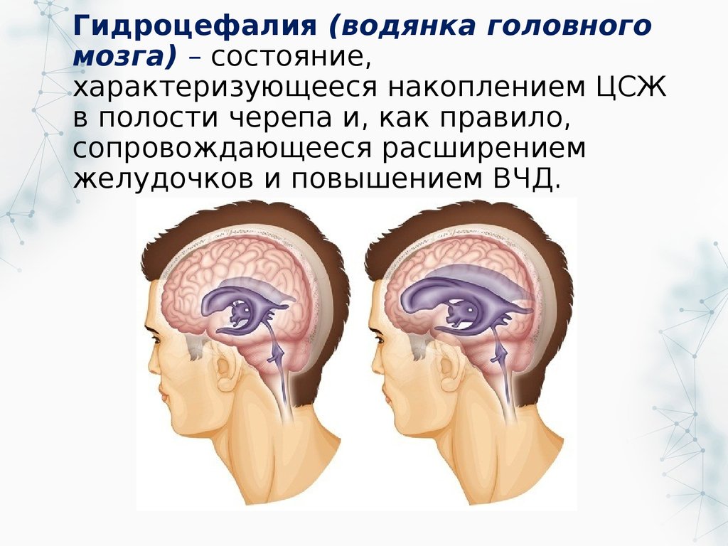 Мр картина умеренно выраженной наружной заместительной гидроцефалии что это