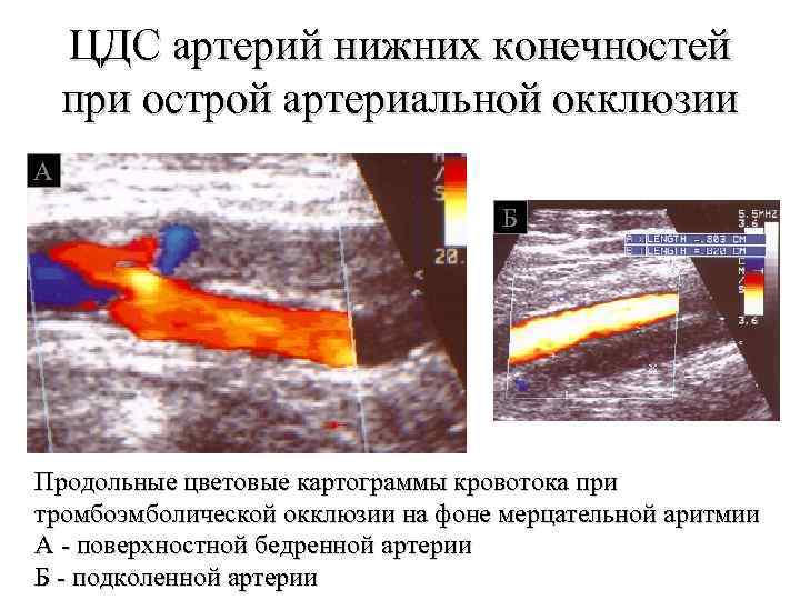 Доплер нижних конечностей. УЗИ допплерография артерий нижних конечностей. Окклюзия подколенной артерии на УЗИ. Допплеровское сканирование сосудов нижних конечностей. Атеросклероз артерий нижних конечностей на УЗИ.