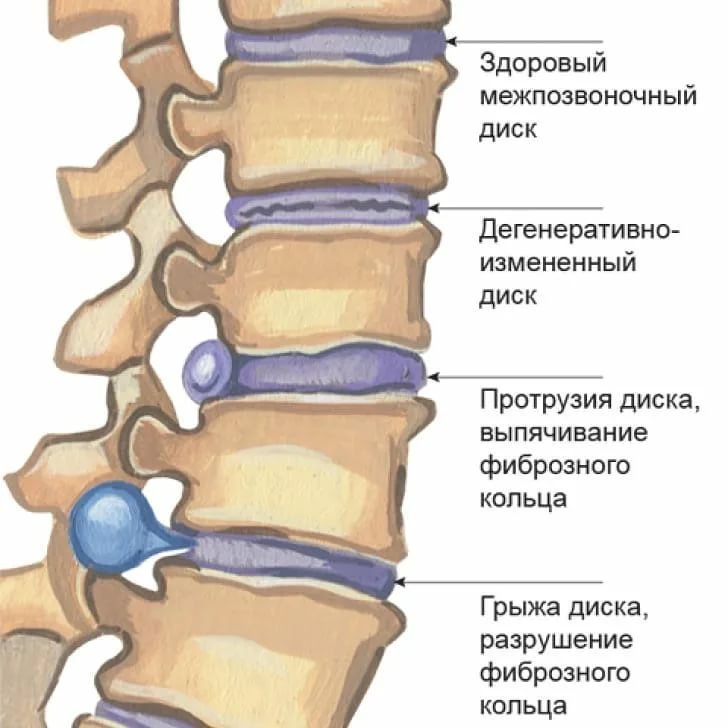 Протрузия позвоночника. Лфк при грыжах и протрузиях. Протрузия межпозвонкового диска c5-c6. Видео протрузии шейного позвоночника. Протрузия шейного отдела позвоночника.