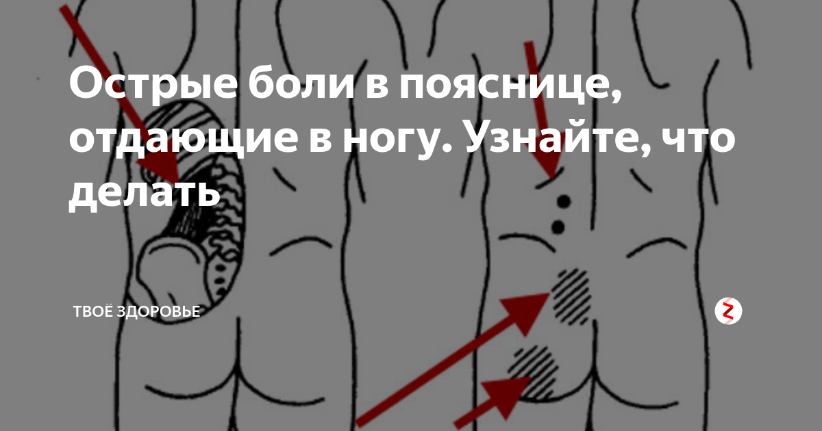 Между заднем проходом и яичками. Локализация боли в спине. Ноющие ощущения в правой ягодице. Поясница отдает в ногу.