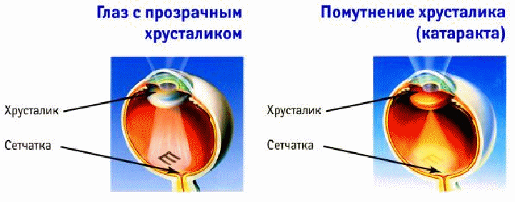 Факосклероз хрусталика глаза что. Прозрачный хрусталик. Прозрачность хрусталика обеспечивается. Хрусталик защита глаза. Хрусталики для глаза отличие.