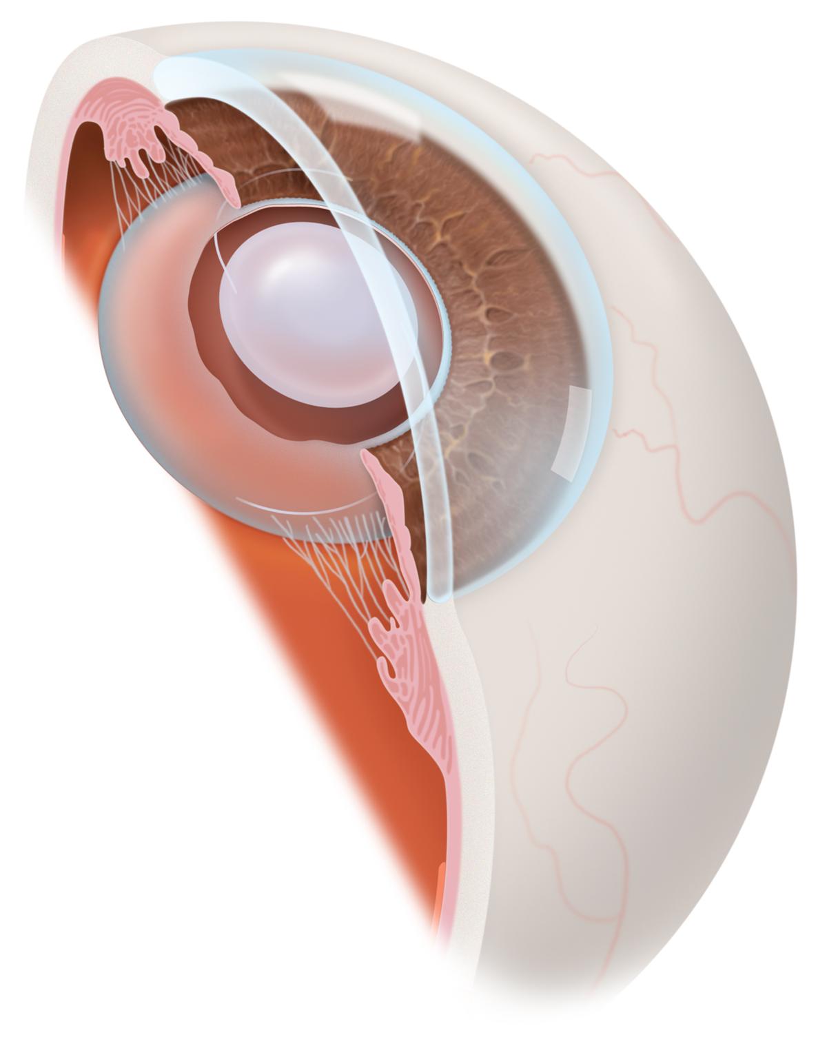 Вторичная катаракта после операции. Вторичная катаракта лазерная дисцизия. Катаракта хрусталик строение. Лазерная дисцизия задней капсулы хрусталика.