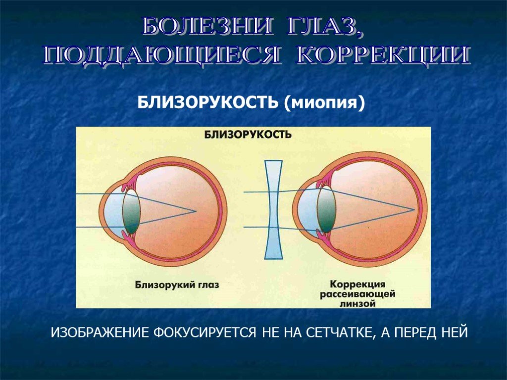 Заболевание близорукости. Близорукость. Заболевание глаз миопия. Близорукость сетчатка. Близорукость миопия.