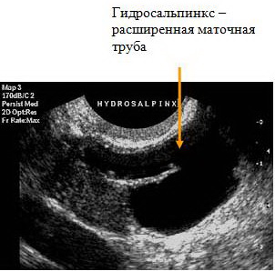 Узи труб. Жидкость в трубе матки УЗИ. Гидросальпинкс маточных труб. Расширение маточной трубы на УЗИ. УЗИ признаки гидросальпинкса.