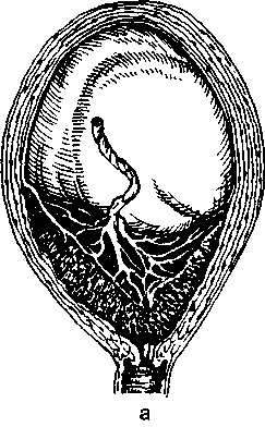 Хорион по передней стенке доходит до внутреннего зева