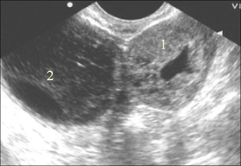Внематочная эндометрий. На УЗИ беременность внематочная беременность на яичнике. Желтое тело в яичнике внематочная беременность. Внематочная беременность в яичнике на УЗИ. Апоплексия кисты желтого тела.