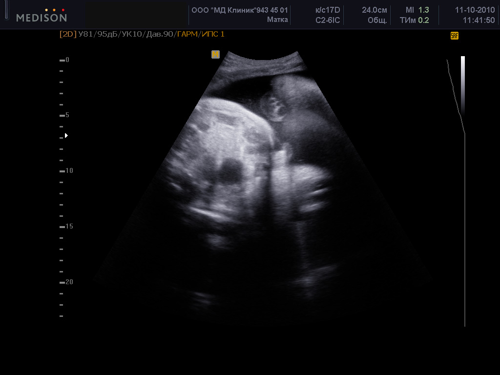 Узи см. 4 Д УЗИ определение пола. Как правильно смотреть по УЗИ. Видео ли на УЗИ третьего.