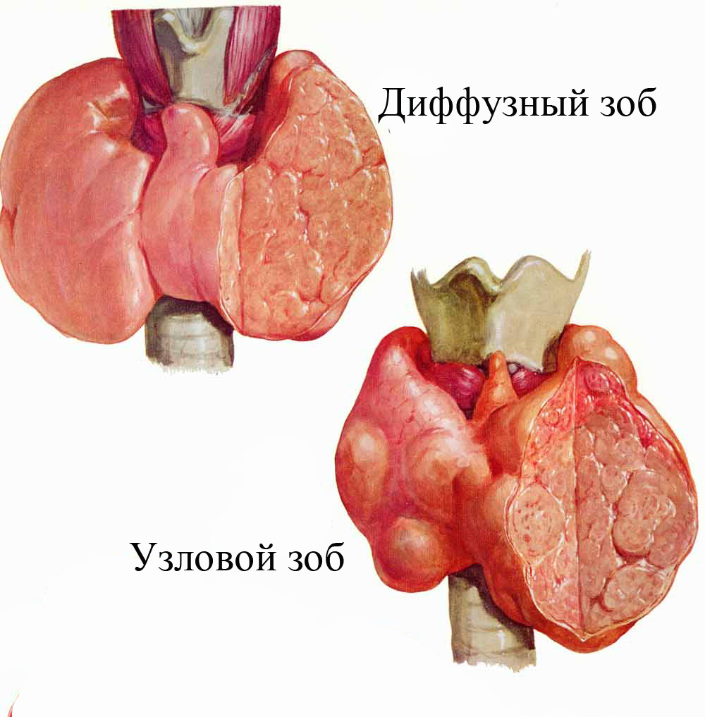 Диффузный нетоксичный. Узловая форма щитовидной железы. Диффузно-Узловой зоб макропрепарат. Узловая Струма щитовидной железы что это такое. Диффузный токсический зоб и многоузловой зоб.