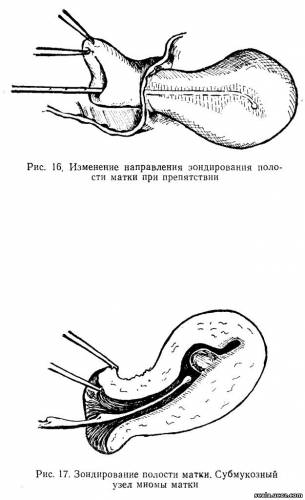 Контроль полости матки. Зондирование матки при гематометре. Зондирование и выскабливание полости матки. Зондирование матки показания. Введение маточного зонда.