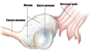 Функциональная киста яичника