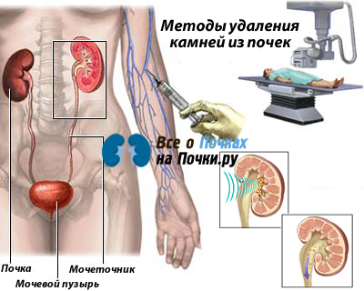 Лечение почек у мужчин. Терапия при Камне в почке. Лекарство при камнях в почках у мужчин. Пиелонефрит камни в почках. Боль при камнях в почках у мужчин.