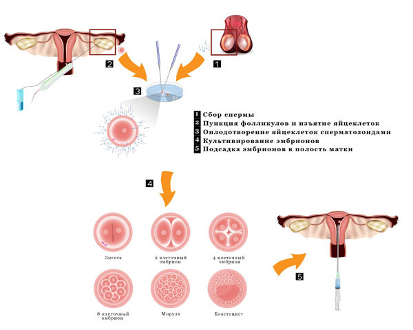Схема метода экстракорпорального оплодотворения