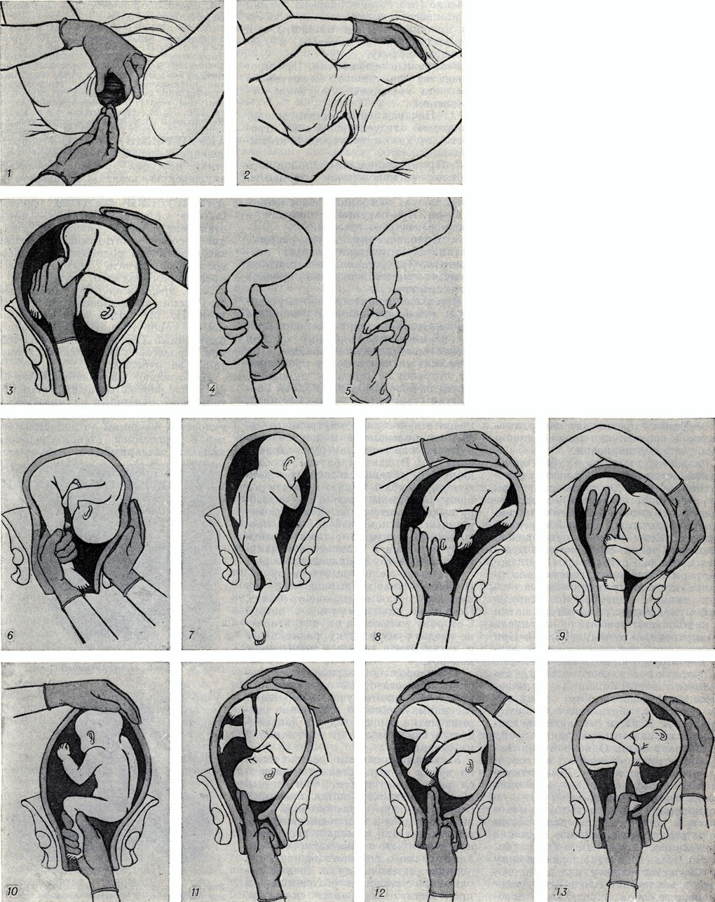 Перевернутые положения. Внешний акушерский переворот плода. Наружный акушерский поворот при тазовом предлежании. Внутренний переворот акушерский плода. Внутренний акушерский поворот плода комбинированный.