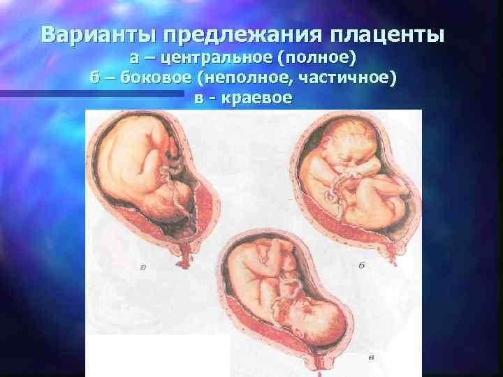 Центральное предлежание плаценты