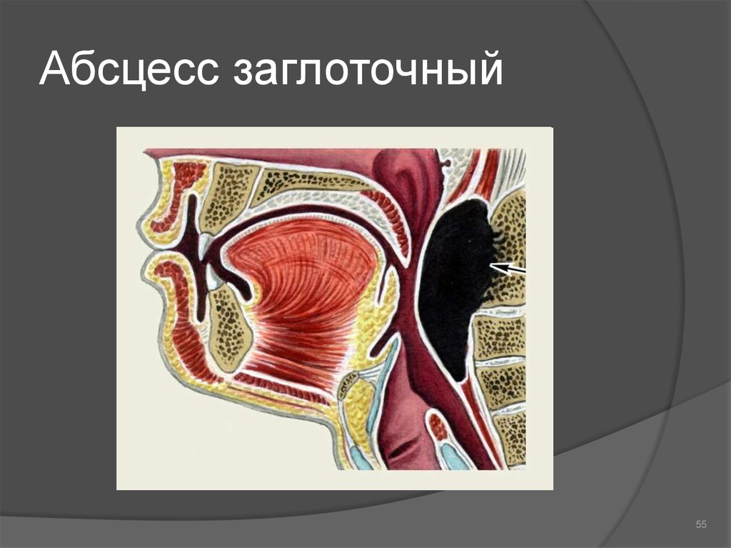 Стенка абсцесса