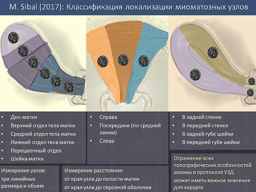 Фиго миома. Классификация локализации миоматозных узлов. Миома матки классификация Figo. Ультразвуковая классификация миомы матки Figo. Figo классификация миомы матки 2020.