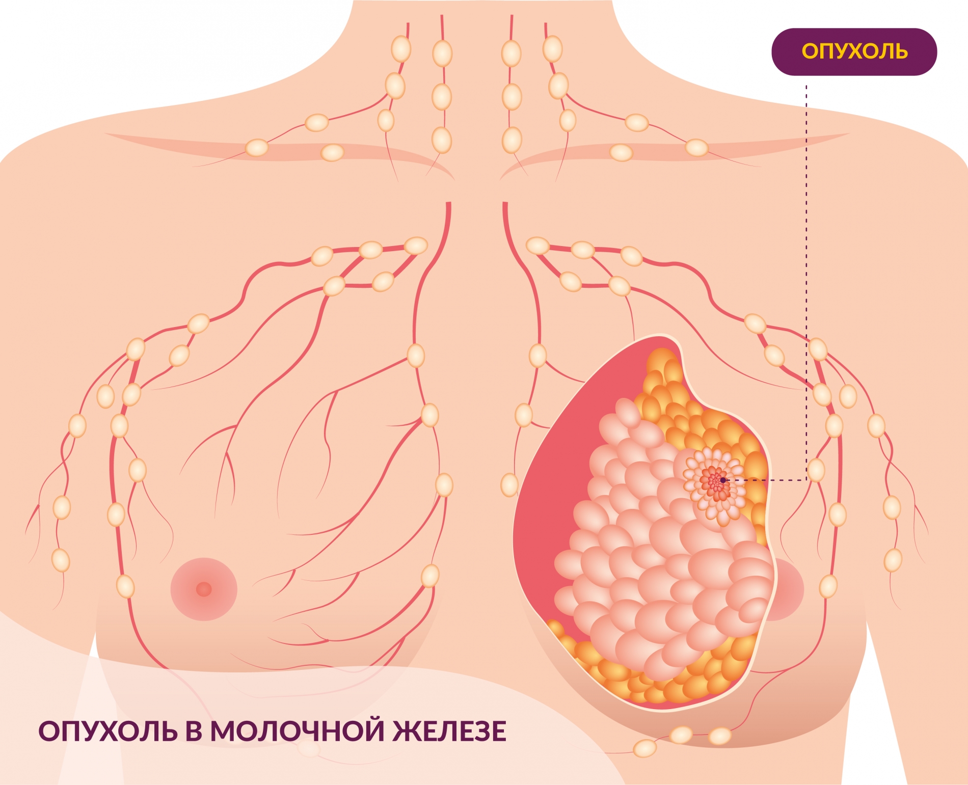 Рак Молочной Железы Картинки