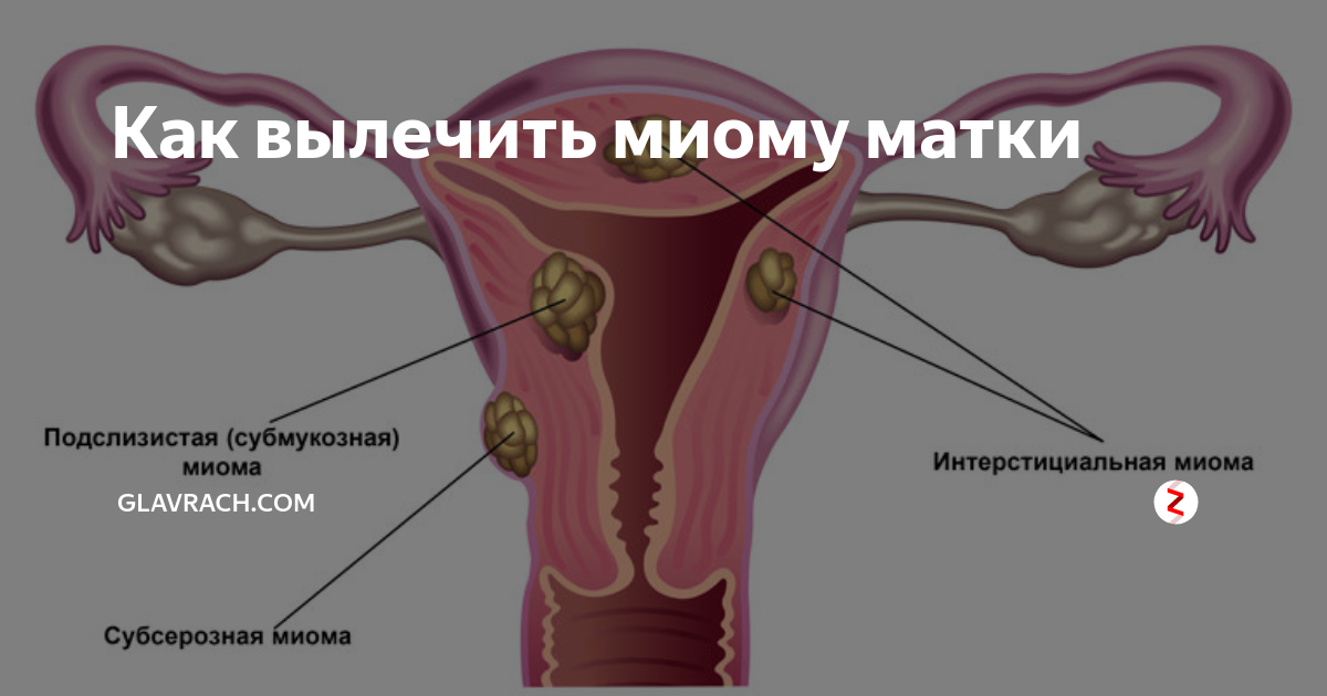 Что такое миома матки у женщин. Миомы матки расположение. Женское заболевание миома. Шеечно перешеечная миома.